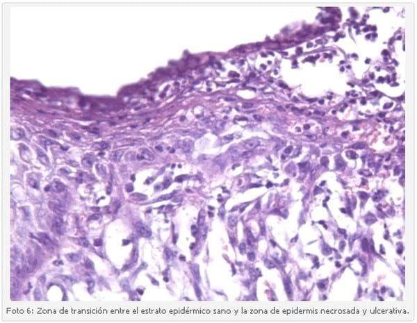 Vasculitis Leucocitoclástica en un Cachorro Scottish Terrier. - Image 6