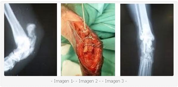 Fractura del Calcáneo. A Propósito de dos Casos Clínicos. - Image 1