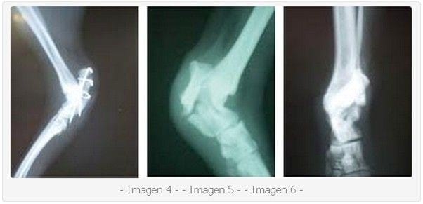 Fractura del Calcáneo. A Propósito de dos Casos Clínicos. - Image 2