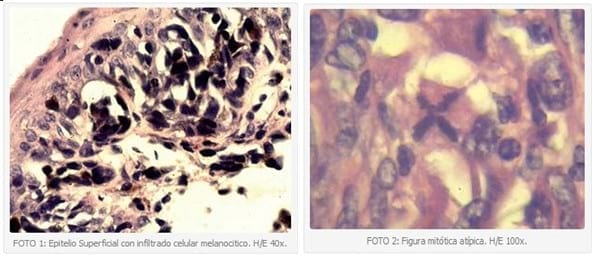 Neoplasias melanocíticas en caninos, medición de la actividad de proliferación celular mediante la inmunoreactividad de antígeno Ki67. Informe preliminar. - Image 1