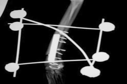 Reparación de fracturas radio-cubitales y complicaciones - Image 1