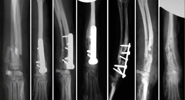 Reparación de fracturas radio-cubitales y complicaciones - Image 4