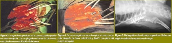 Malaunión en un caso de fractura escapular múltiple - Image 2