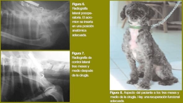 Malaunión en un caso de fractura escapular múltiple - Image 3