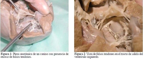 Miocardiopatía por falsos tendones en ventrículo izquierdo