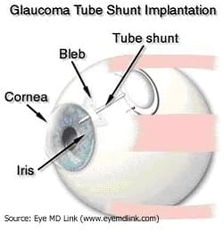 Cirugía del Glaucoma: Gonioimplante - Image 2