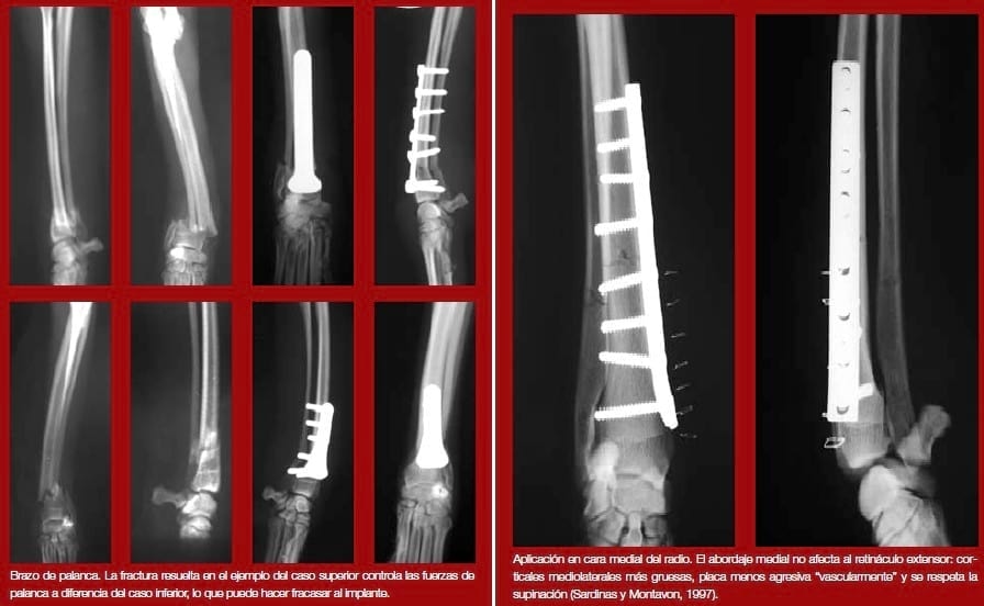 Complicaciones de fracturas reparadas con placas y tornillos - Image 4