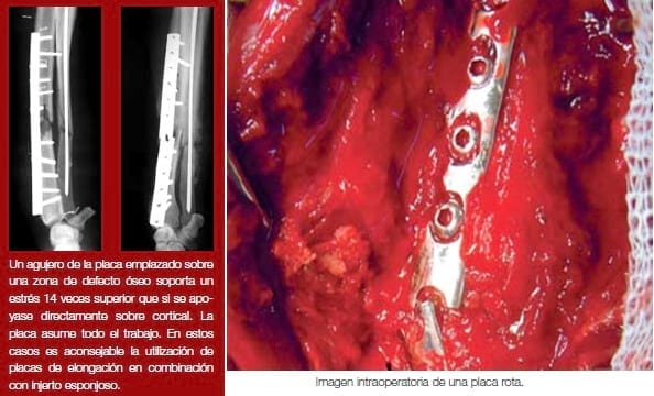 Complicaciones de fracturas reparadas con placas y tornillos - Image 11