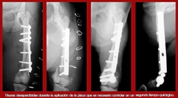 Complicaciones de fracturas reparadas con placas y tornillos - Image 10
