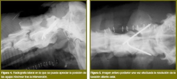 Luxación vertebral atlanto-axial traumática - Image 3