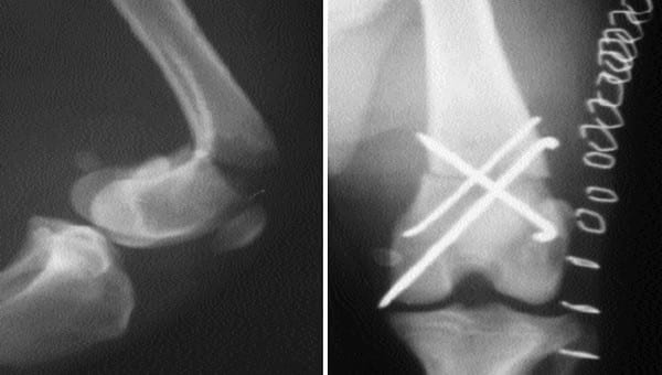 Fracturas supracondilares de fémur - Image 2