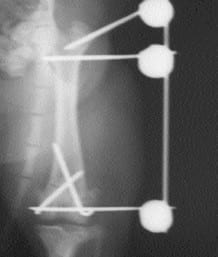 Fracturas supracondilares de fémur - Image 5
