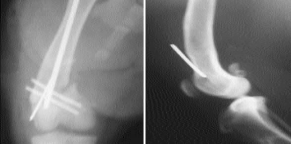 Fracturas supracondilares de fémur - Image 3