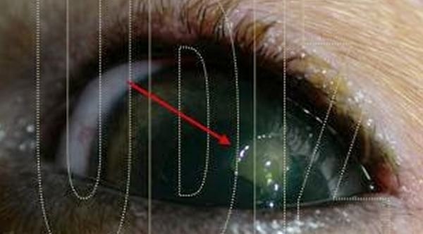 Traumatismo Ocular y Cuerpo Extraño - Image 3