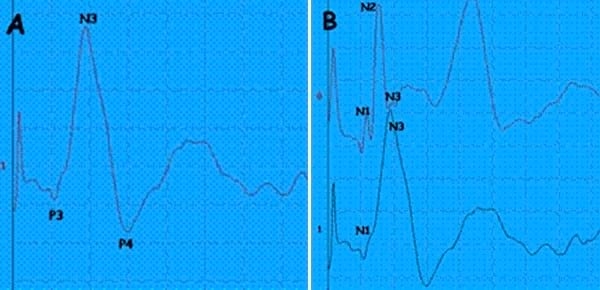 EVALUACION DE LA FUNCION SOMATOSENSITIVA: POTENCIALES EVOCADOS SOMATOSENSITITVOS - Image 3