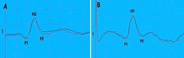 EVALUACION DE LA FUNCION SOMATOSENSITIVA: POTENCIALES EVOCADOS SOMATOSENSITITVOS - Image 7
