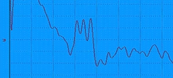 EVALUACION DE LA FUNCION SOMATOSENSITIVA: POTENCIALES EVOCADOS SOMATOSENSITITVOS - Image 4