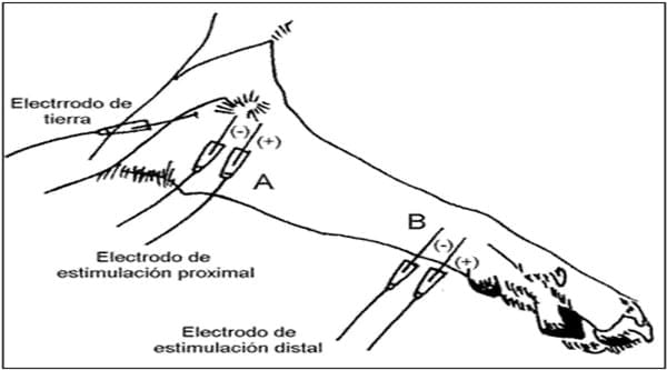 EVALUACION DE LA FUNCION SOMATOSENSITIVA: POTENCIALES EVOCADOS SOMATOSENSITITVOS - Image 6