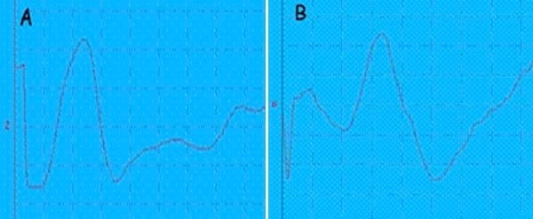 EVALUACION DE LA FUNCION SOMATOSENSITIVA: POTENCIALES EVOCADOS SOMATOSENSITITVOS - Image 5