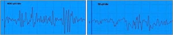 EVALUACION DE LA FUNCION NEUROMUSCULAR: ELECTRONEUROMIOGRAFIA - Image 7