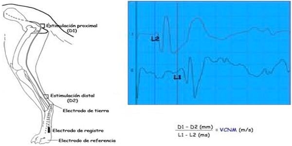 EVALUACION DE LA FUNCION NEUROMUSCULAR: ELECTRONEUROMIOGRAFIA - Image 11