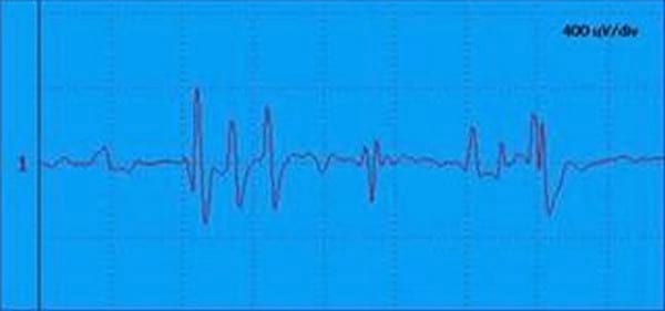 EVALUACION DE LA FUNCION NEUROMUSCULAR: ELECTRONEUROMIOGRAFIA - Image 6