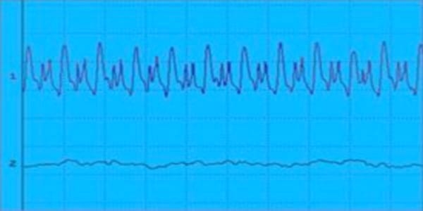 EVALUACION DE LA FUNCION NEUROMUSCULAR: ELECTRONEUROMIOGRAFIA - Image 5