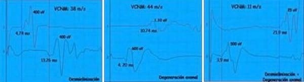 EVALUACION DE LA FUNCION NEUROMUSCULAR: ELECTRONEUROMIOGRAFIA - Image 12