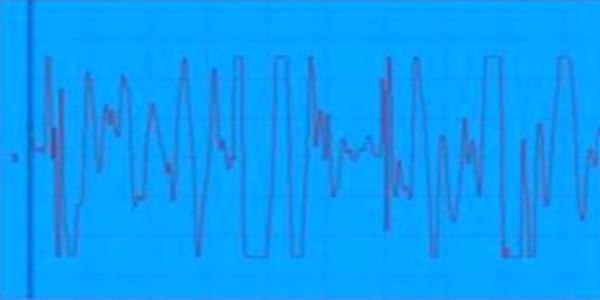 EVALUACION DE LA FUNCION NEUROMUSCULAR: ELECTRONEUROMIOGRAFIA - Image 2