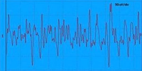 EVALUACION DE LA FUNCION NEUROMUSCULAR: ELECTRONEUROMIOGRAFIA - Image 10