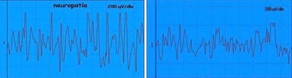 EVALUACION DE LA FUNCION NEUROMUSCULAR: ELECTRONEUROMIOGRAFIA - Image 9