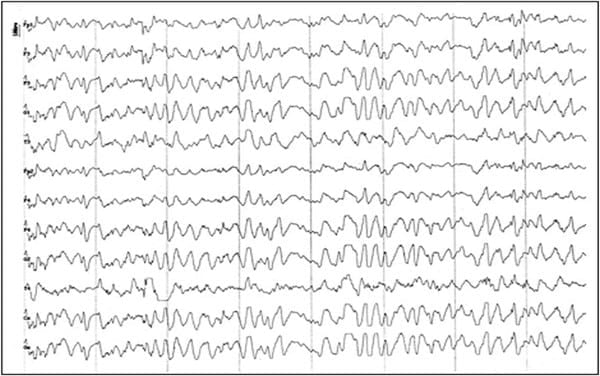 EVALUACION DE LA FUNCION CEREBRAL: ELECTROENCEFALOGRAFIA CLINICA EN PEQUEÑOS ANIMALES - Image 5