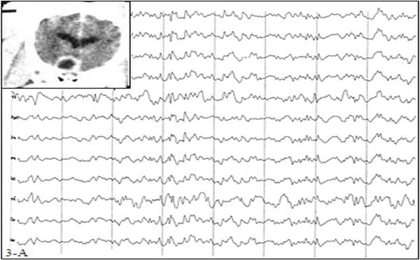 EVALUACION DE LA FUNCION CEREBRAL: ELECTROENCEFALOGRAFIA CLINICA EN PEQUEÑOS ANIMALES - Image 3