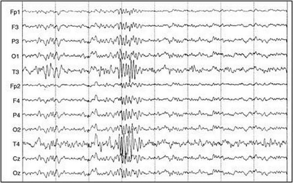 EVALUACION DE LA FUNCION CEREBRAL: ELECTROENCEFALOGRAFIA CLINICA EN PEQUEÑOS ANIMALES - Image 2