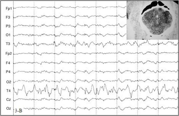EVALUACION DE LA FUNCION CEREBRAL: ELECTROENCEFALOGRAFIA CLINICA EN PEQUEÑOS ANIMALES - Image 4