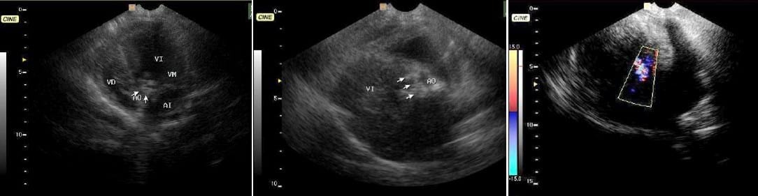 ENDOCARDITIS BACTERIANA: REPORTE DE CASO - BACTERIAL ENDOCARDITIS: CASE REPORT - Image 2