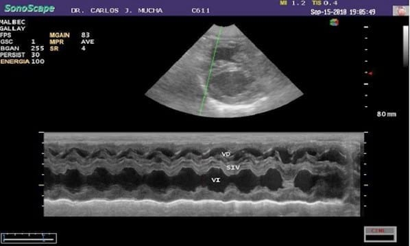 Primer reporte en Argentina del cierre quirúrgico de una comunicación interauricular con oclusión circulatoria. - Image 9