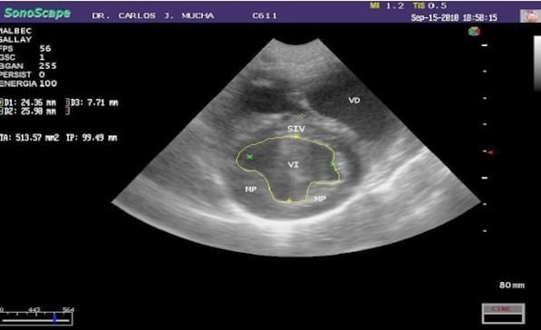 Primer reporte en Argentina del cierre quirúrgico de una comunicación interauricular con oclusión circulatoria. - Image 5