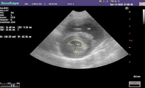 Primer reporte en Argentina del cierre quirúrgico de una comunicación interauricular con oclusión circulatoria. - Image 6