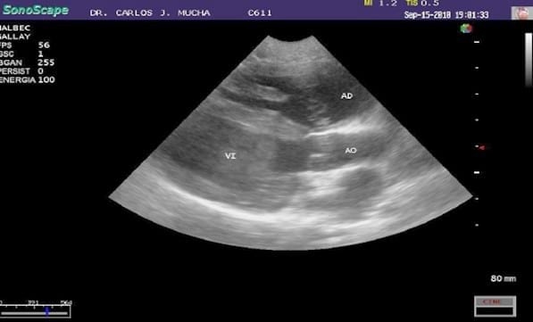 Primer reporte en Argentina del cierre quirúrgico de una comunicación interauricular con oclusión circulatoria. - Image 7