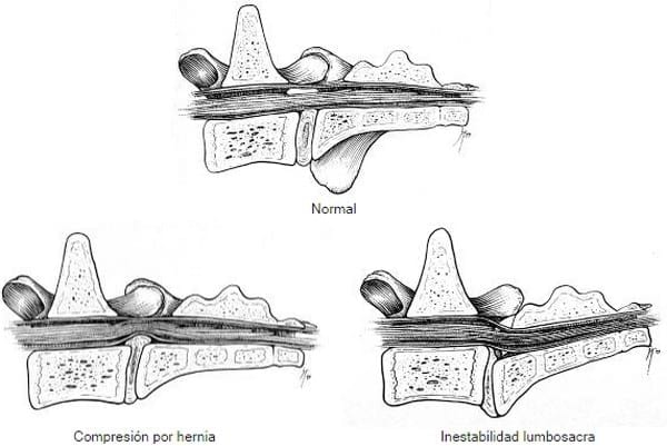 ESTENOSIS DEGENERATIVA LUMBOSACRA (EDL) - Enfermedad Lumbosacra - Image 1