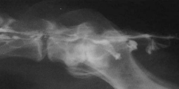 ESTENOSIS DEGENERATIVA LUMBOSACRA (EDL) - Enfermedad Lumbosacra - Image 2