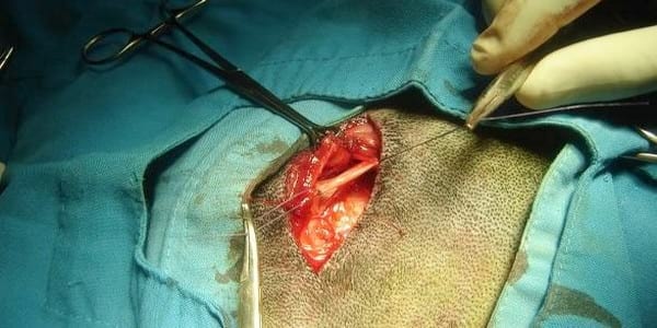 ASPECTOS BASICOS DE LA BIOPSIA DEL NERVIO PERONEAL COMUN - Image 3