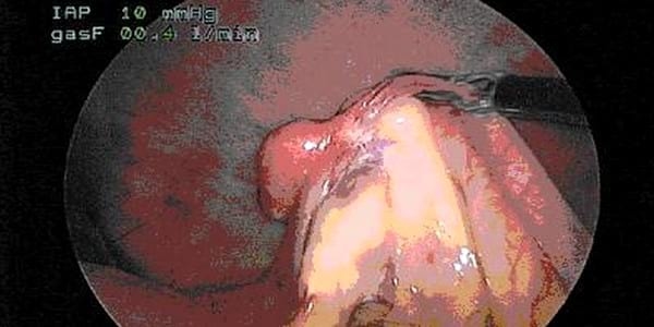 Ovariectomía laparoscópica: una alternativa mínimamente invasiva para la esterilización. - Image 1