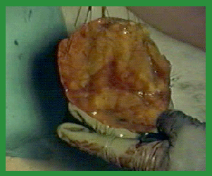 Manual de anestesias y cirugías de bovinos: Cirugías de Abdomen - Image 60