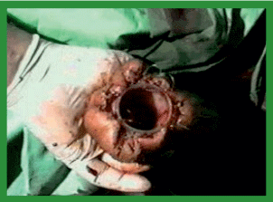 Manual de anestesias y cirugías de bovinos: Cirugías aparato reproductor del macho - Image 21
