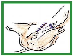 Manual de anestesias y cirugías de bovinos: Cirugías aparato reproductor del macho - Image 14