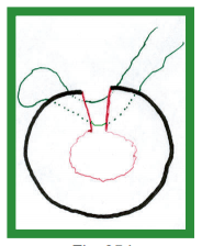 Manual de anestesias y cirugías de bovinos: Cirugías de los pezones - Image 4