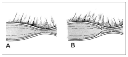 Estenosis yeyunal congenita en una ternera holstein con 