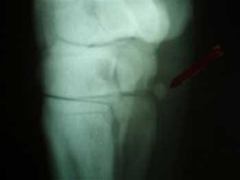 Luxación y/o fractura del primer hueso del carpo y su solución quirúrgica - Image 2